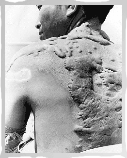File:Hiroshima victim keloid scars.gif